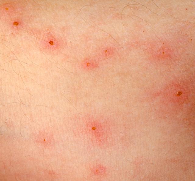 疱疹传染的途径有哪些病毒性疱疹有哪些注意事项