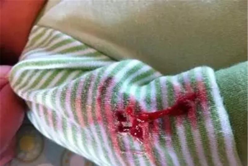 出生才一周的宝宝口吐血块吓坏宝妈,大夫一语,宝妈长舒一口气