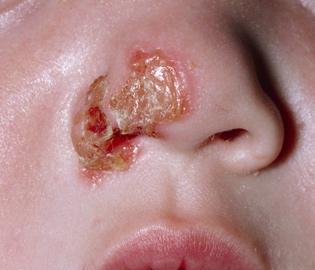 六个新生儿身体常见症状, 宝妈们该怎么应对