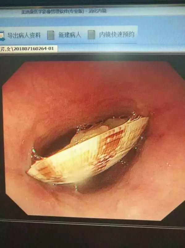威海老媪囫囵吞蛤卡在食道