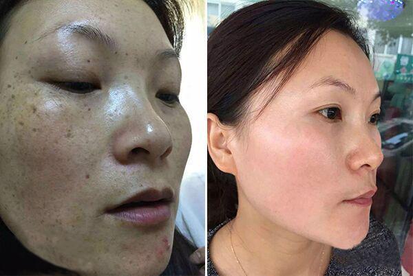 洋葱配上白醋每天抹一次独一无二的祛斑效果堪比果酸换肤