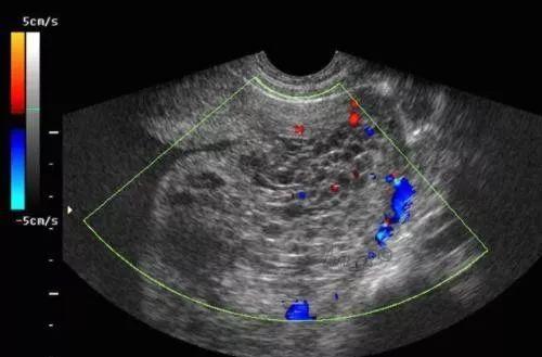 什么原因会怀上葡萄胎?