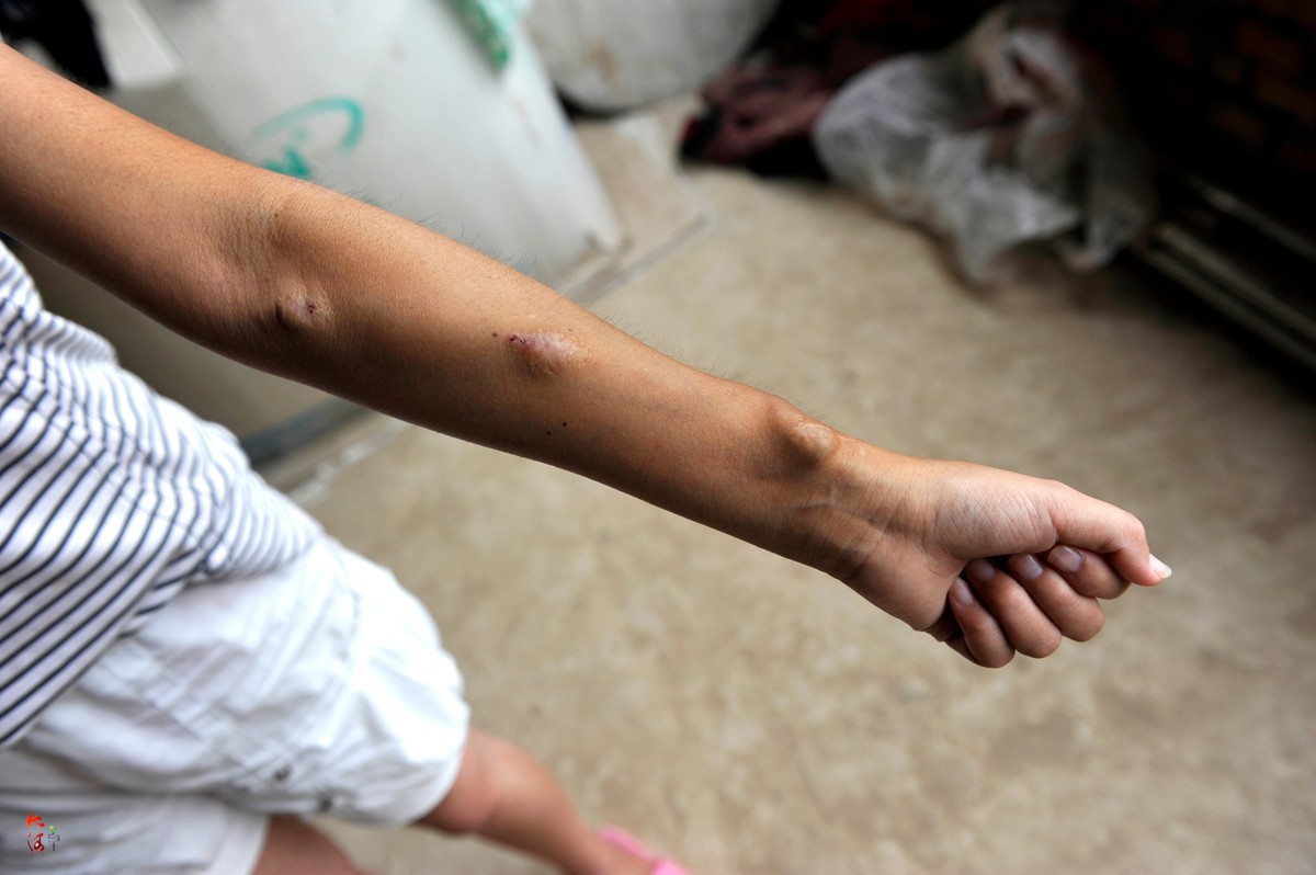 农村女孩患尿毒症7年无钱换肾全家借住毛坯房妹妹被蚊子咬哭