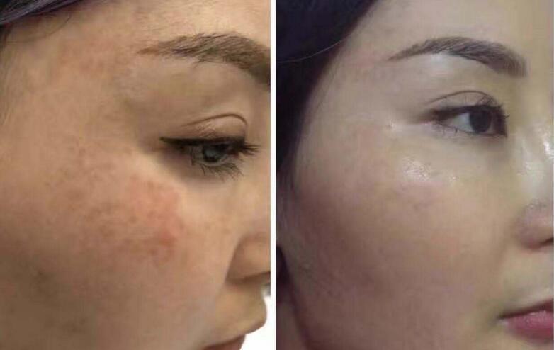 一旦祛除原有部分不会再长出来,常见的有:遗传斑,雀斑,老年斑,色素痣