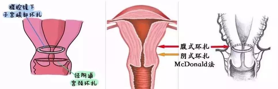 怀孕5月子宫口大开,广东医生用一根神奇丝线帮孕妈
