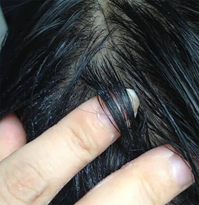 头上螨虫泛滥4个信号正中下怀运用3招轰走螨虫不敢来