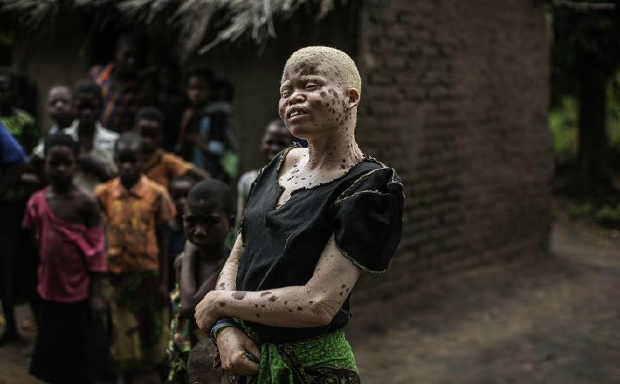 镜头下,一群患病的可怜非洲人,因为迷信,竟沦为商品被人买卖