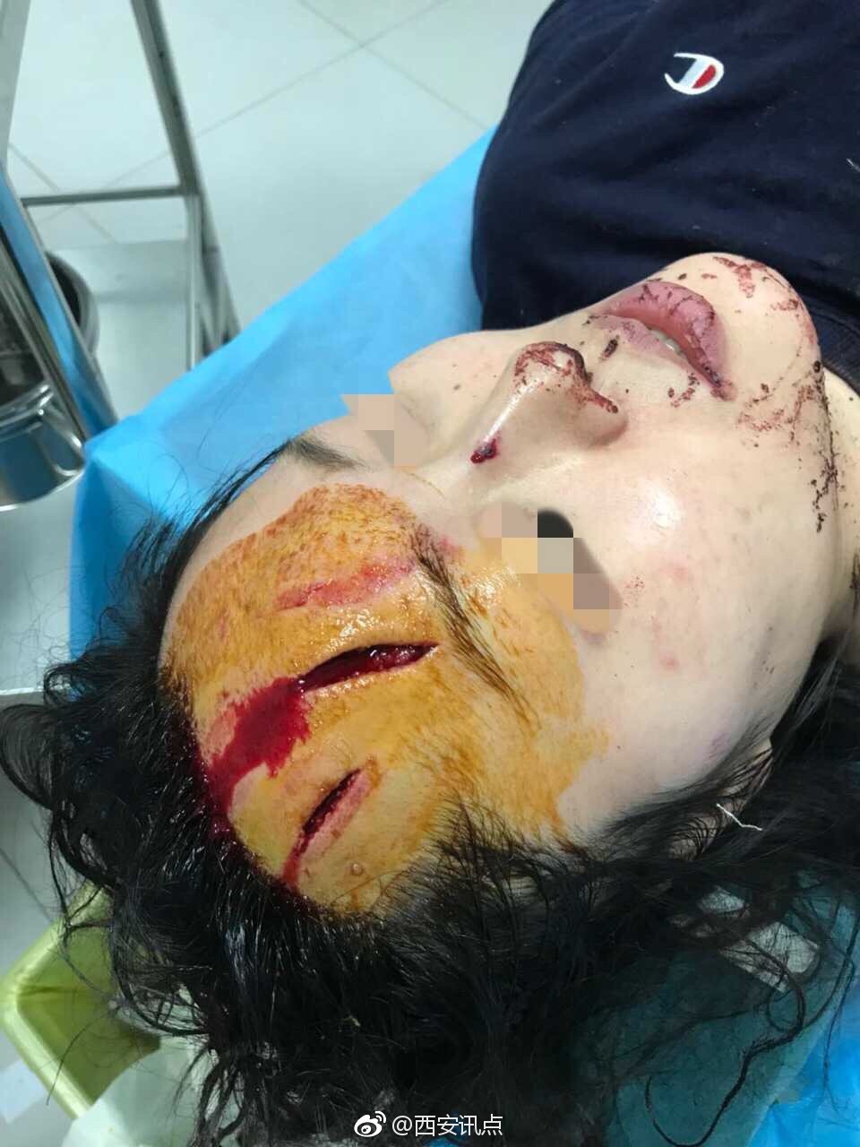 女子家中与丈夫口角问题被家暴 照片血腥胆小勿点[话筒]