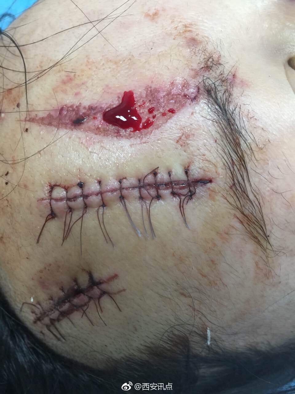 女子家中与丈夫口角问题被家暴 照片血腥胆小勿点[话筒]