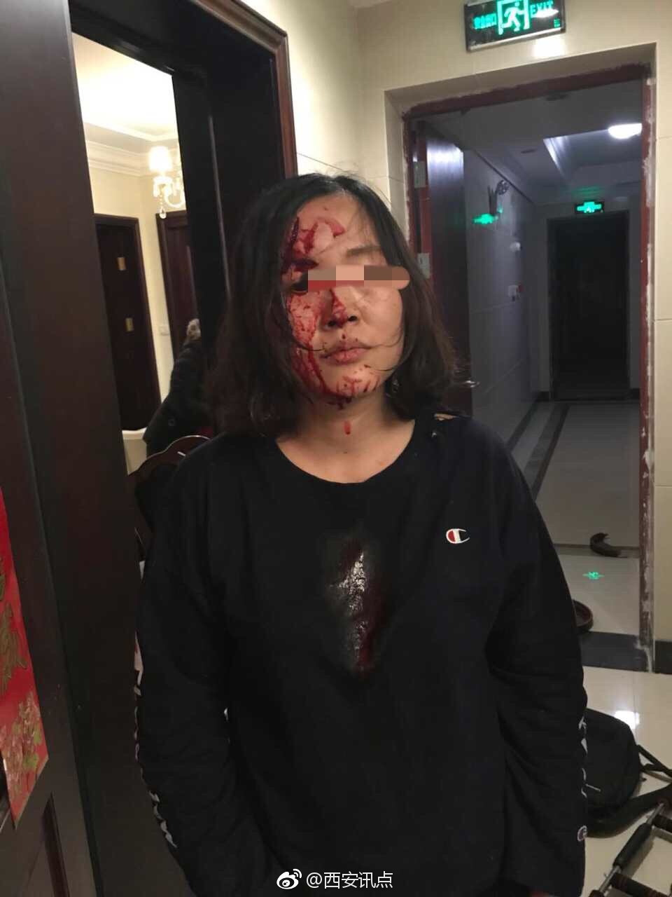 女子家中与丈夫口角问题被家暴 照片血腥胆小勿点[话筒]