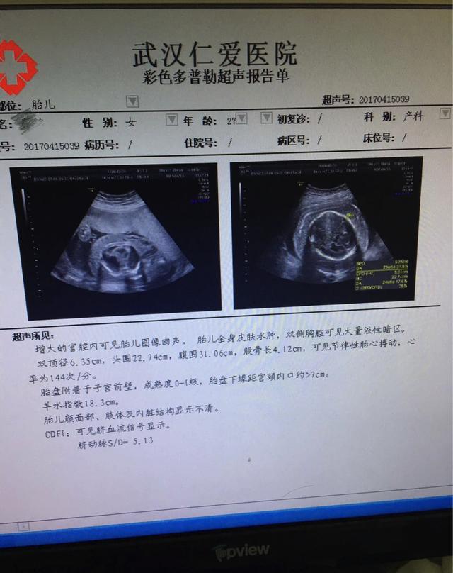 该院超声影像科王娟主任介绍,蔡丽怀孕26周,看起来肚子却像足月的产妇