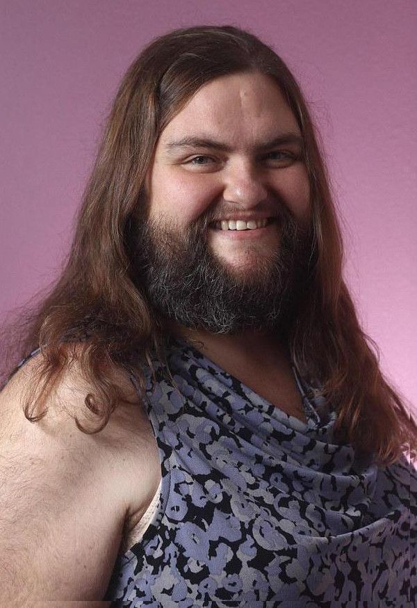 39岁女子患怪病,脸上长满络腮胡,还长有胸毛,如同一个壮汉