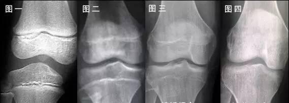 骨骺线随着年龄和骨龄的不断成熟由宽变窄直至闭合,在这期间,生长激素