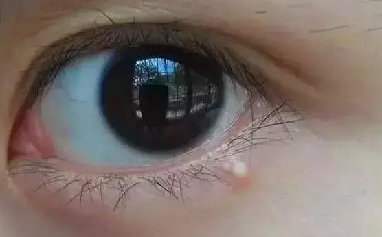 梅梅护肤老师脂肪粒是怎么形成的如何去除