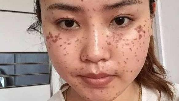 产科医生讲诉产后如何去妊娠纹妊娠斑产后肥胖