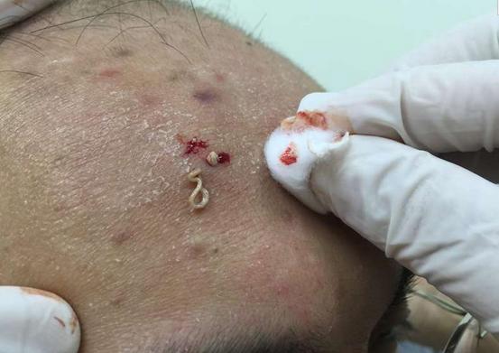 挤痘痘时流出来的「白色物质」到底是什么?