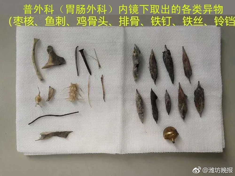 小铃铛卡食管 潍坊 四龄童险丧命|食管|铃铛|异物_新浪网