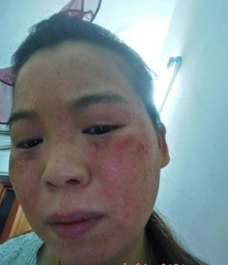 这位女士祛斑不成全脸溃烂你还敢在美容院做激光美容吗