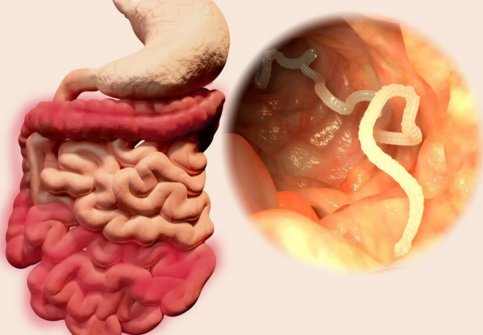 肚子里有寄生虫大便会出现这个信号你注意到了吗