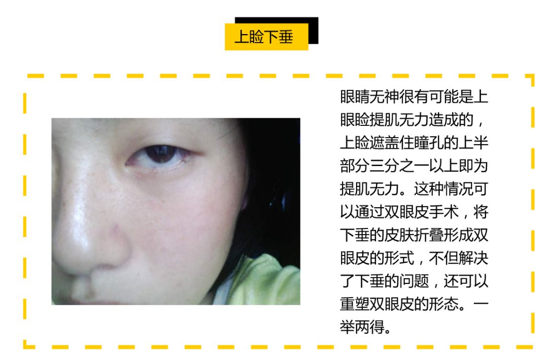 9大眼部问题汇总单眼皮的姑娘请对照