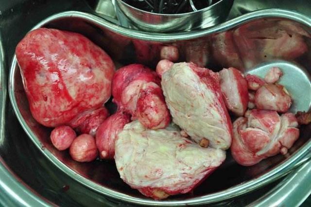 子宫肌瘤排出来是什么样子的图片"堂堂正正"-第1张图片-维普博客