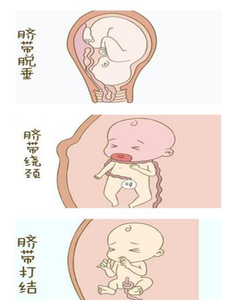 脐带知识知多少孕妈妈看看就知道
