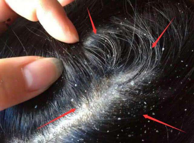 2种草是除螨王中王用来洗头修复头皮损伤扼杀螨虫于摇篮