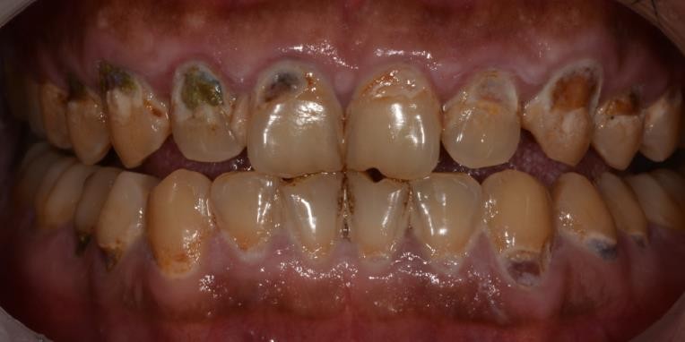 19岁女孩把碳酸饮料当水喝,一年后牙竟被"溶解"|碳酸饮料|牙齿|女孩