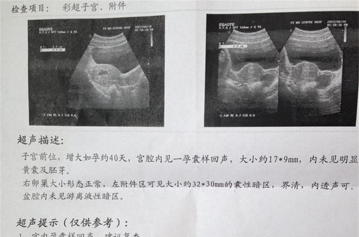 刚怀孕1个月啥感觉也没有? 但这些小症状很多