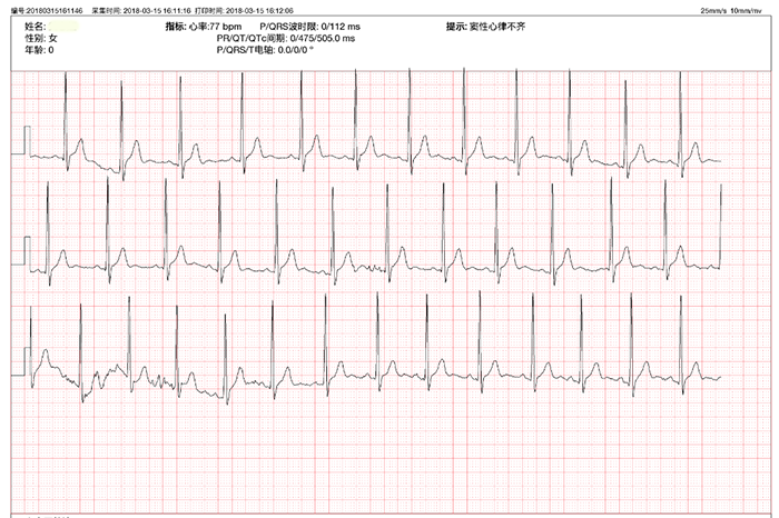 这可能是最全的窦性心律不齐治疗方法详解!