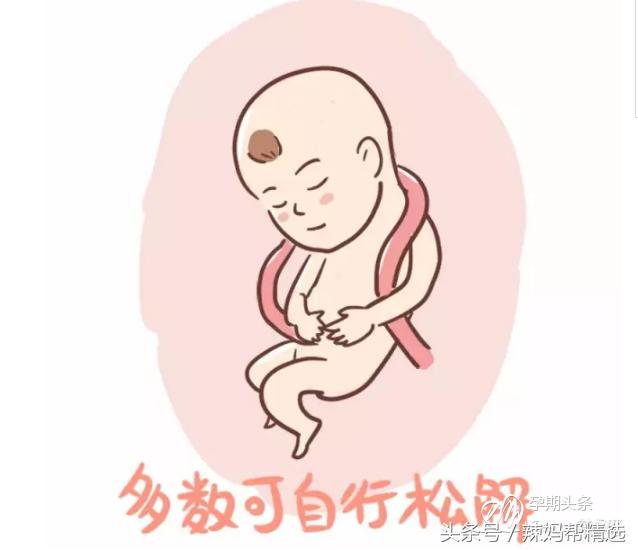 男宝脐带绕颈更常见这事居然分男女
