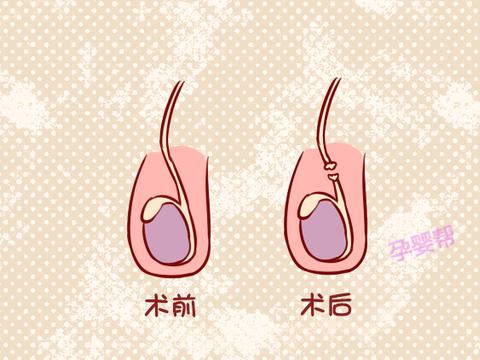 男人结扎后,精子会把睾丸撑破?不会的!