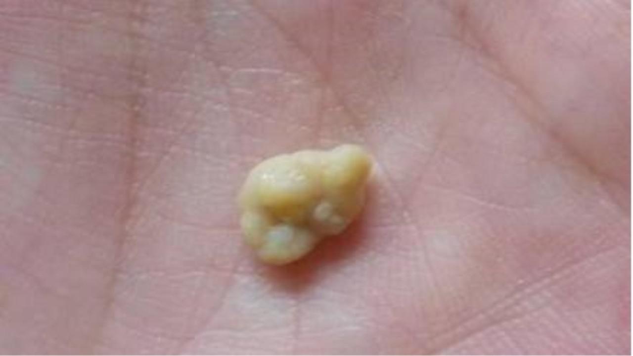 咳嗽吐出来的臭石头,到底是什么东西?看完整个人都不好了