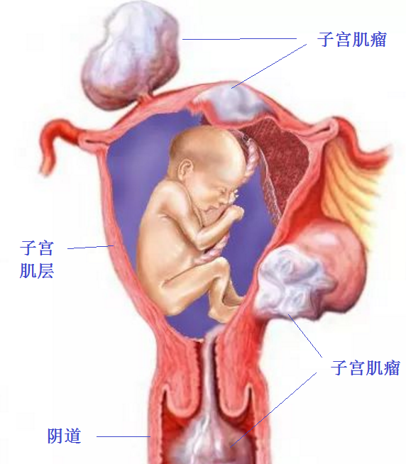 妊娠合并子宫肌瘤美国医生怎么处理