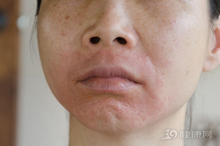 一到春天就"红脸"?医生:外出时谨记"一要两不要"!