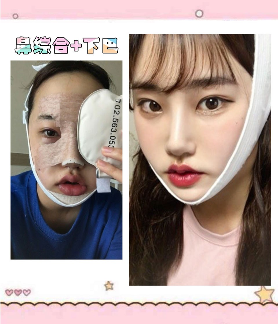 凸嘴脸宽人中长?下半脸不上镜的问题今天一起解决!
