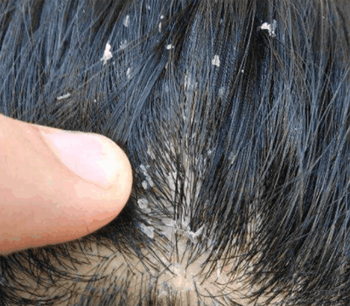 步入三伏天4信号不能忽视警告头螨爆红灯花店买2物秒除螨