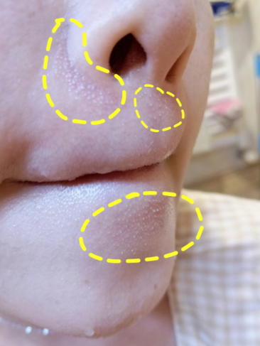 脸上鼻翼两侧下巴有鸡皮肤的简单介绍 脸上鼻翼两侧下巴有鸡皮肤的简单介绍
