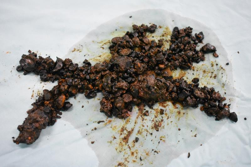 疯狂的石头!五旬男子肝内取出半斤结石,罪魁祸首竟是蛔虫!