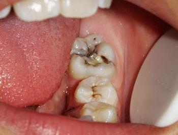 牙髓炎引起的疼痛有什么特点?