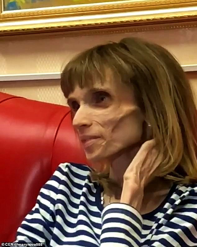 厌食症女孩仅34斤瘦得像干尸,在医生帮助下吃了今年的第一顿饭