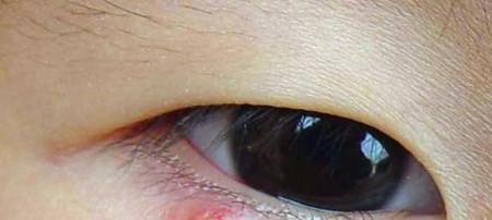 眼睛的隐形杀手—螨虫