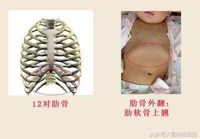 宝宝肋骨外翻是缺钙