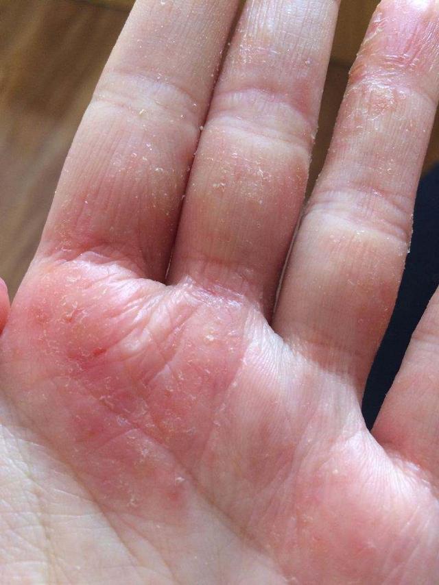 一到夏天,手上就起小水泡,超痒,还能挤出"水",怎么办|汗疱疹|水泡