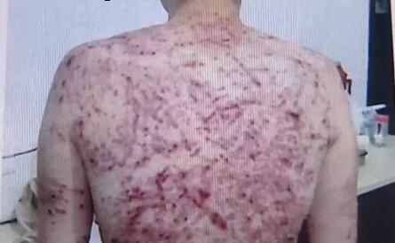 女子遭再婚丈夫细竹条鞭打 头发被剪全身伤痕累累