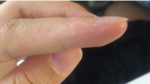 30年老中医:秋季汗疱疹反反复复,奇痒难耐!别只抹药,不治本!