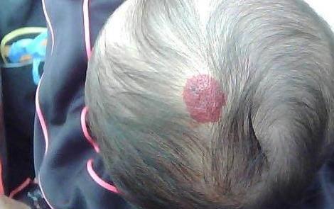 宝宝身上出现这样的小红点,家长千万不要大意,马上去医院