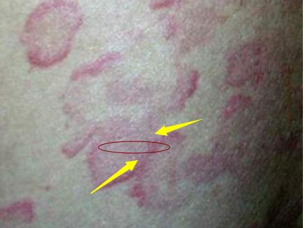 甲醛初期红疹图片图片
