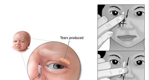 新生儿泪囊炎按摩手法图解 简单实用