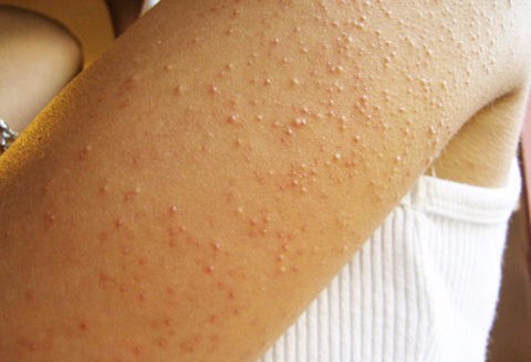 鸡皮肤冬天干燥怎么办(鸡皮肤冬天干燥怎么办呢)